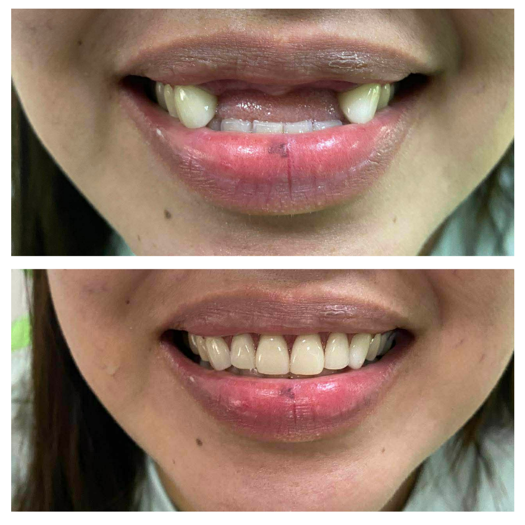 partial dentures