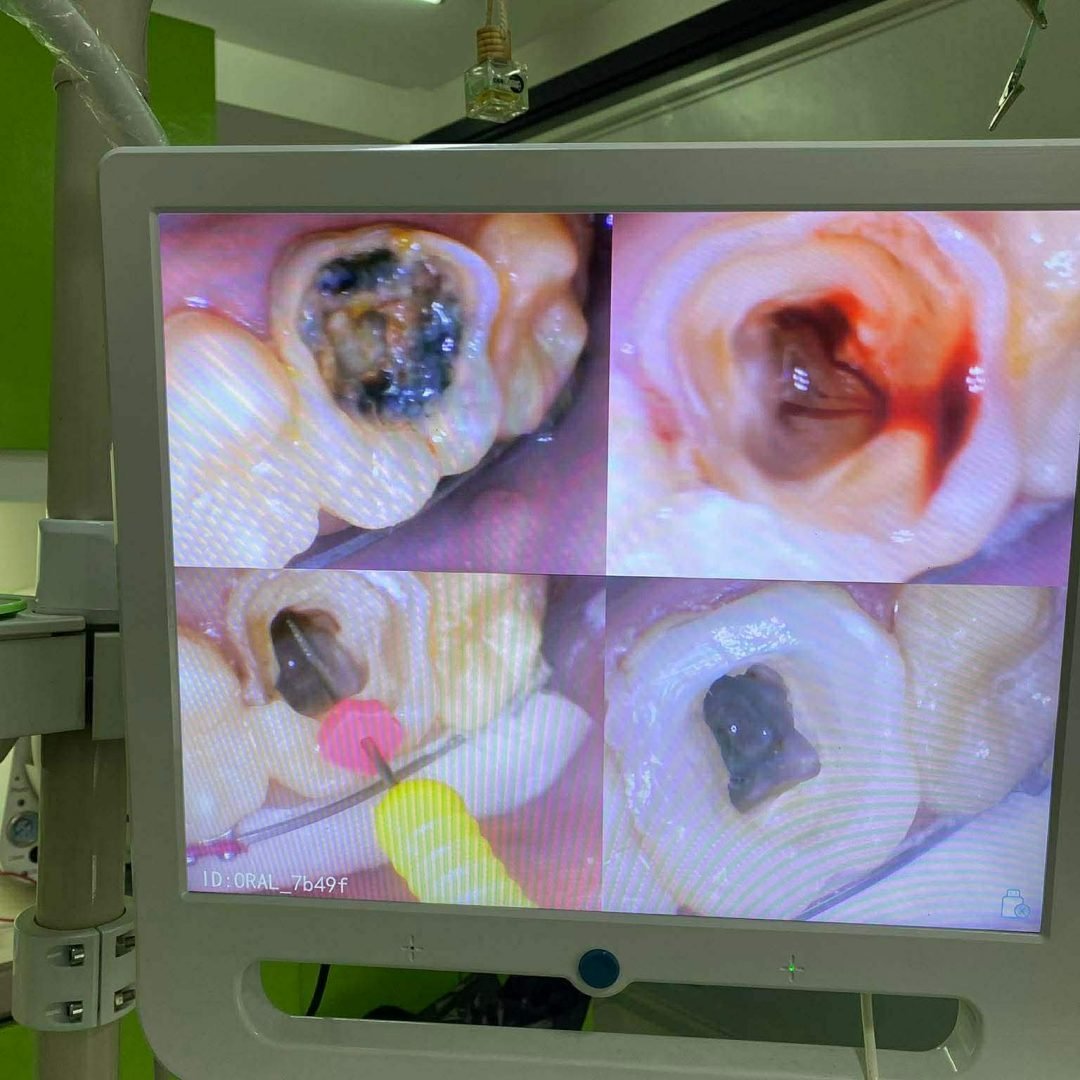 root canal